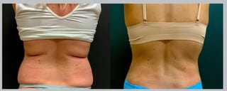 Before and after 360 Body Contour case 32602 - Angle 3