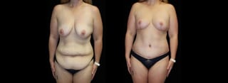 Before and after Mommy Makeover case 32603 - Angle 1