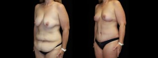 Before and after Mommy Makeover case 32603 - Angle 2