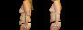 Before and after Mommy Makeover case 32603 - Angle 3