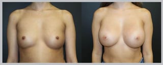 Before and after Breast Augmentation case 32604 - Angle 1