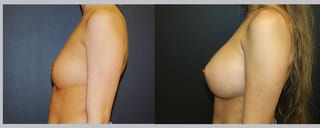 Before and after Breast Augmentation case 32604 - Angle 2