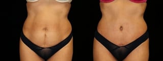 Before and after Tummy Tuck case 32605 - Angle 1