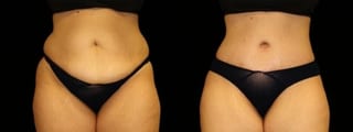Before and after 360 Body Contour case 32606 - Angle 1