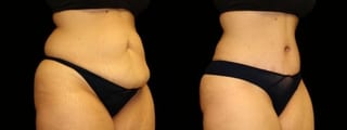 Before and after 360 Body Contour case 32606 - Angle 3
