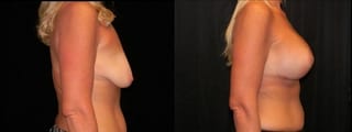 Before and after Breast Augmentation with Lift case 32607 - Angle 3