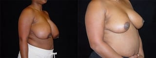 Before and after Breast Reduction case 32608 - Angle 2