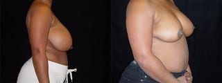 Before and after Breast Reduction case 32608 - Angle 3