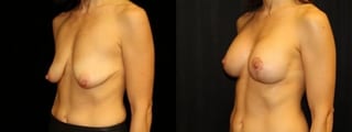 Before and after Breast Augmentation with Lift case 32609 - Angle 2
