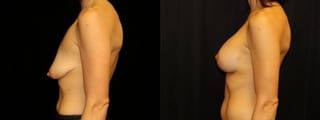 Before and after Breast Augmentation with Lift case 32609 - Angle 3