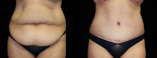 Before and after Tummy Tuck case 32611 - Angle 1