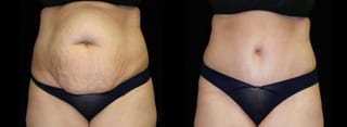 Before and after Tummy Tuck case 32613 - Angle 1