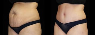 Before and after Tummy Tuck case 32613 - Angle 2