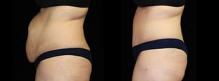 Before and after Tummy Tuck case 32613 - Angle 3