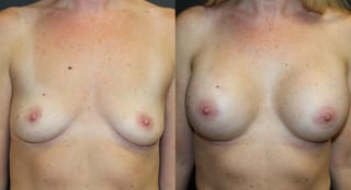 Before and after Breast Augmentation case 32615 - Angle 1