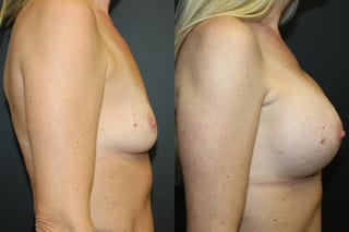Before and after Breast Augmentation case 32615 - Angle 3
