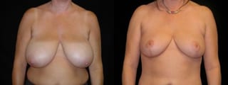 Before and after Breast Reduction case 32618 - Angle 1