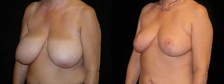 Before and after Breast Reduction case 32618 - Angle 2