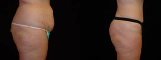 Before and after Tummy Tuck case 32616 - Angle 2