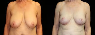 Before and after Breast Reduction case 32619 - Angle 1