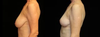 Before and after Breast Reduction case 32619 - Angle 2