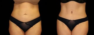 Before and after Tummy Tuck case 32620 - Angle 1