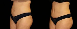 Before and after Tummy Tuck case 32620 - Angle 3