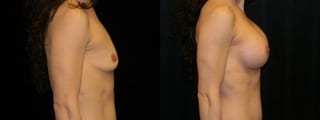 Before and after Breast Augmentation case 32621 - Angle 2