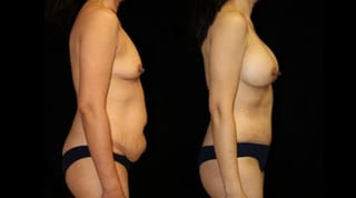 Before and after Mommy Makeover case 32622 - Angle 2