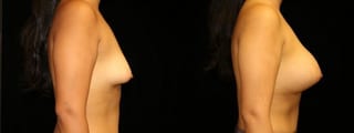 Before and after Breast Augmentation case 32624 - Angle 3