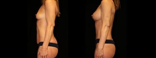 Before and after Mommy Makeover case 32625 - Angle 3