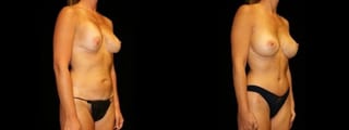Before and after Mommy Makeover case 32628 - Angle 2