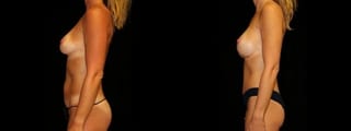 Before and after Mommy Makeover case 32628 - Angle 3