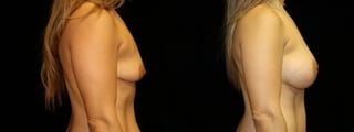 Before and after Mommy Makeover case 32627 - Angle 3
