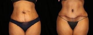 Before and after Tummy Tuck case 32630 - Angle 1