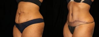Before and after Tummy Tuck case 32630 - Angle 2