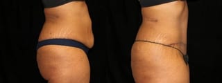 Before and after Tummy Tuck case 32630 - Angle 3