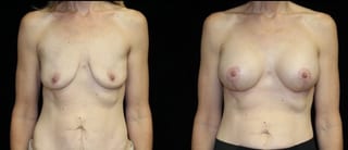 Before and after Breast Augmentation with Lift case 32631 - Angle 1