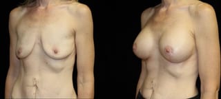 Before and after Breast Augmentation with Lift case 32631 - Angle 2