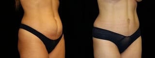 Before and after Tummy Tuck case 32632 - Angle 2