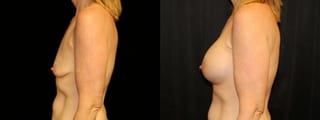 Before and after Breast Augmentation case 32633 - Angle 2