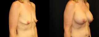 Before and after Breast Augmentation case 32633 - Angle 3
