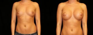 Before and after Breast Augmentation case 32634 - Angle 1