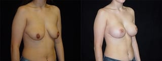 Before and after Breast Augmentation with Lift case 32635 - Angle 2