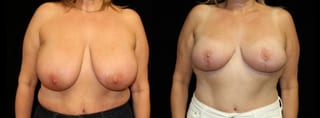 Before and after Breast Reduction case 32640 - Angle 1