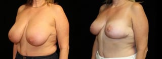 Before and after Breast Reduction case 32640 - Angle 2