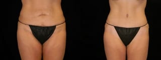 Before and after Mommy Makeover case 32642 - Angle 1
