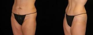 Before and after Mommy Makeover case 32642 - Angle 2