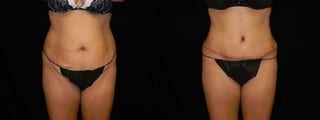 Before and after Tummy Tuck case 32644 - Angle 1