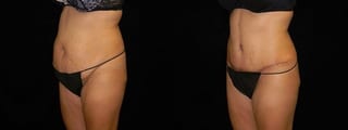Before and after Tummy Tuck case 32644 - Angle 2